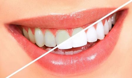 سفید کردن دندان ها بدون هزینه در خانه